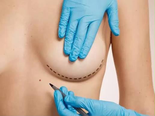 Breast reduction surgery at EsteCenter Istanbul