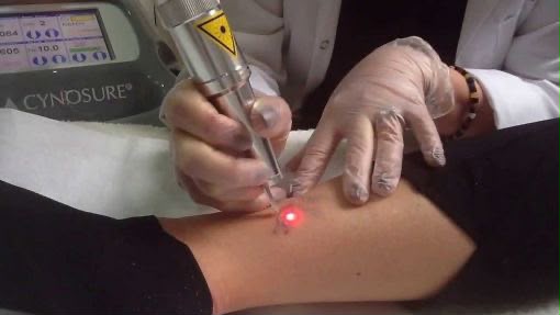 Mydon laser skin treatment at EsteCenter Istanbul