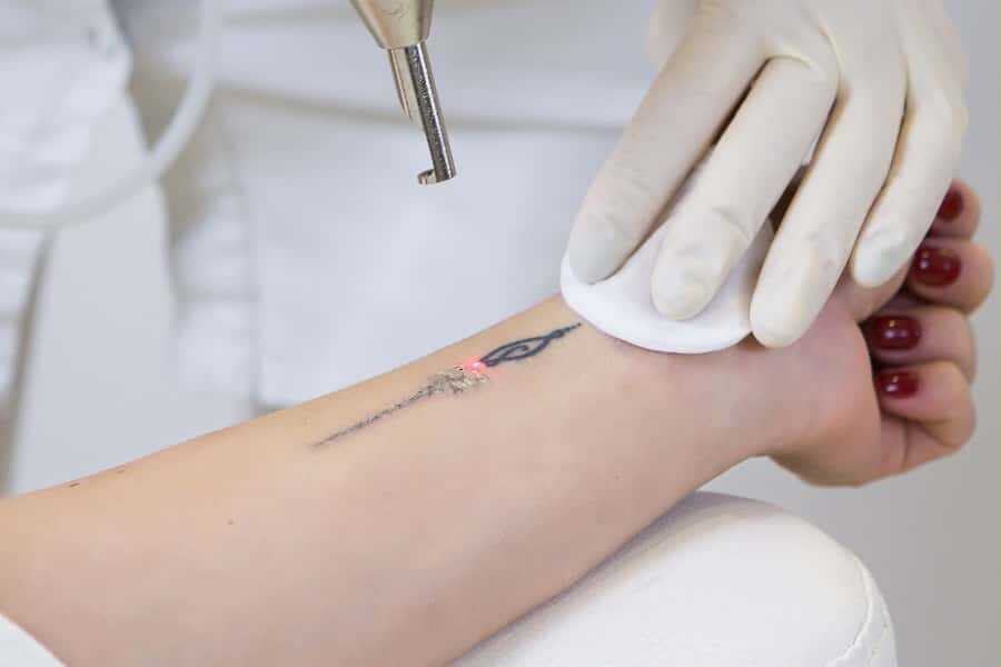 Laser tattoo removal at EsteCenter Istanbul