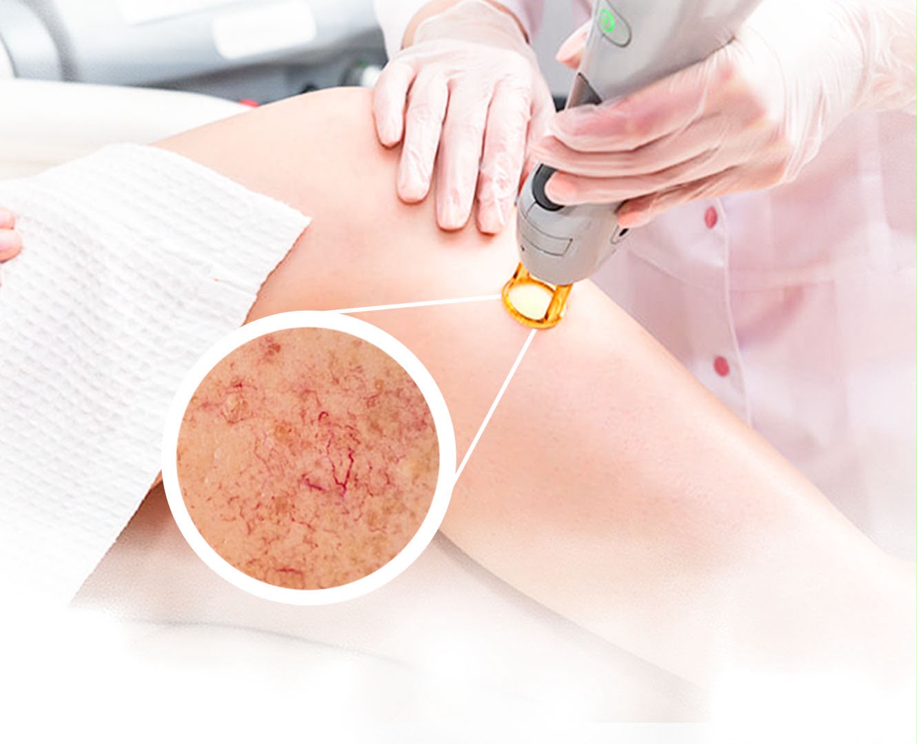 Vascular laser treatment for capillaries at EsteCenter Istanbul